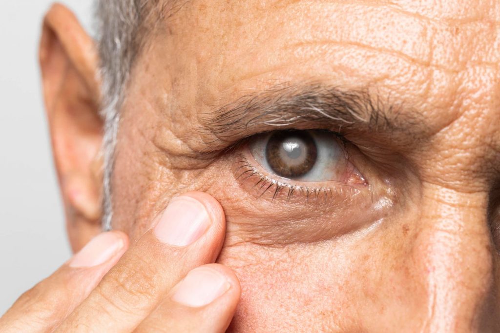 Cataract Surgery